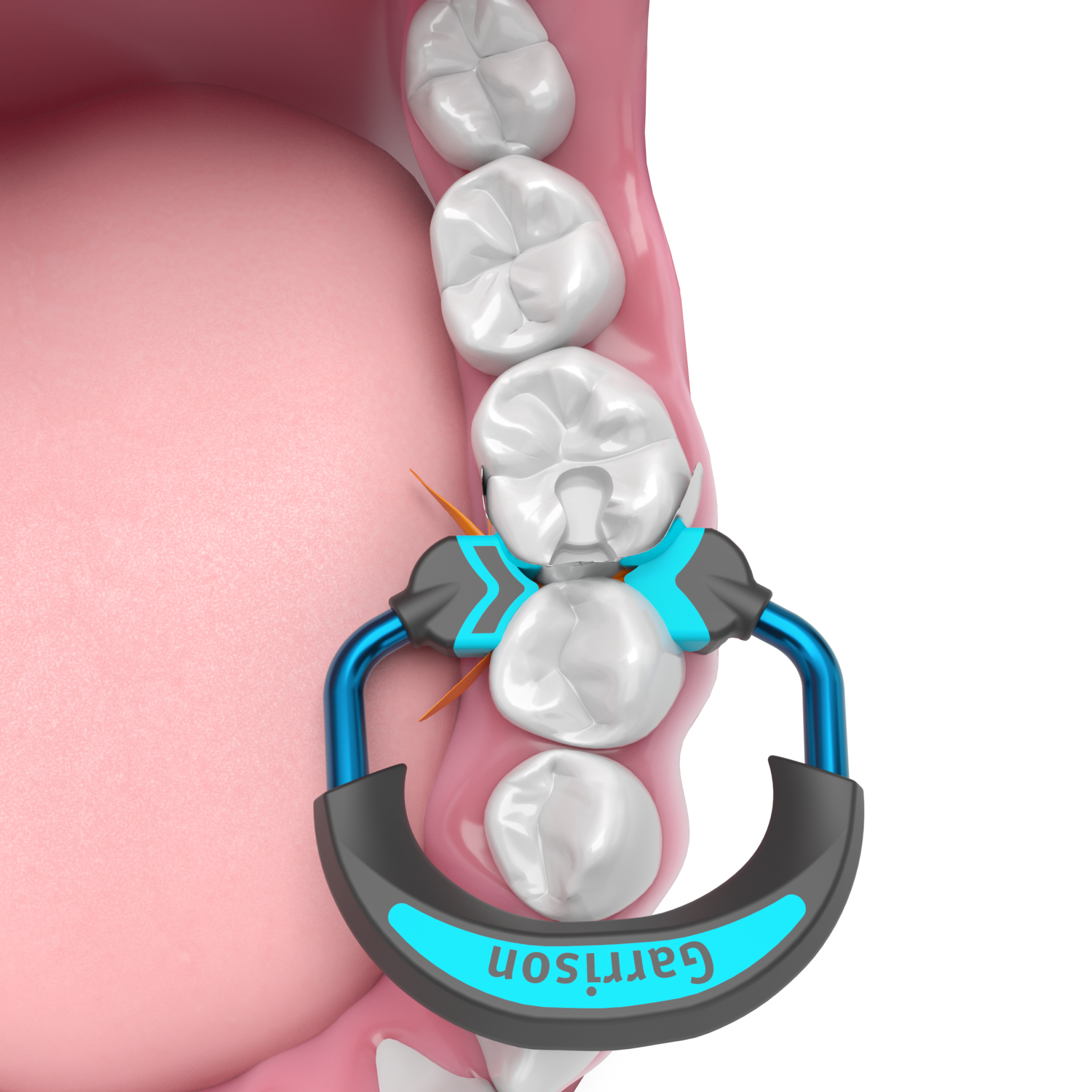 Quad Sectional Matrix System Intro Kit (Q-KHF-10)
