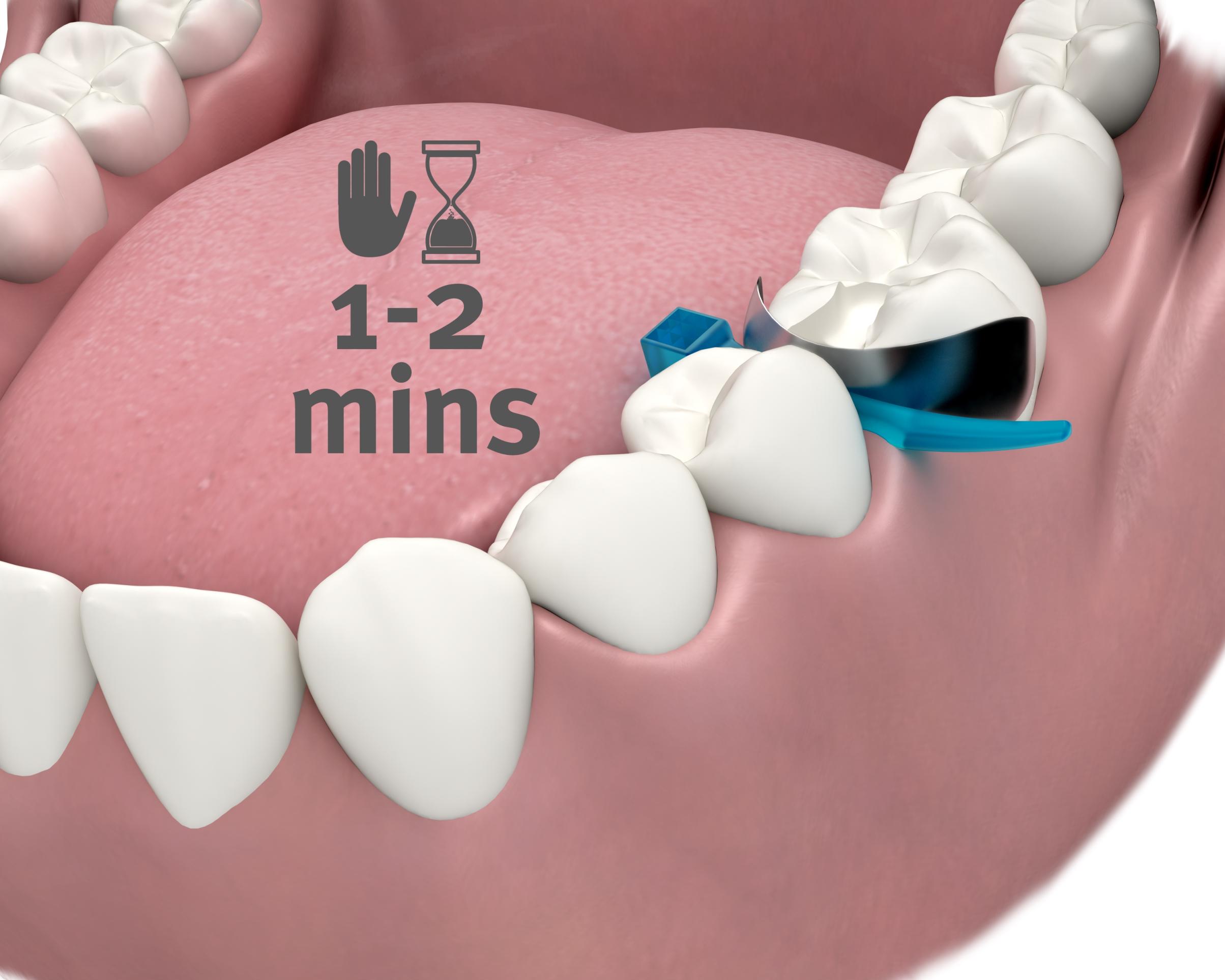 A+ Wedge™ Astringent Interproximal Wedge Refills