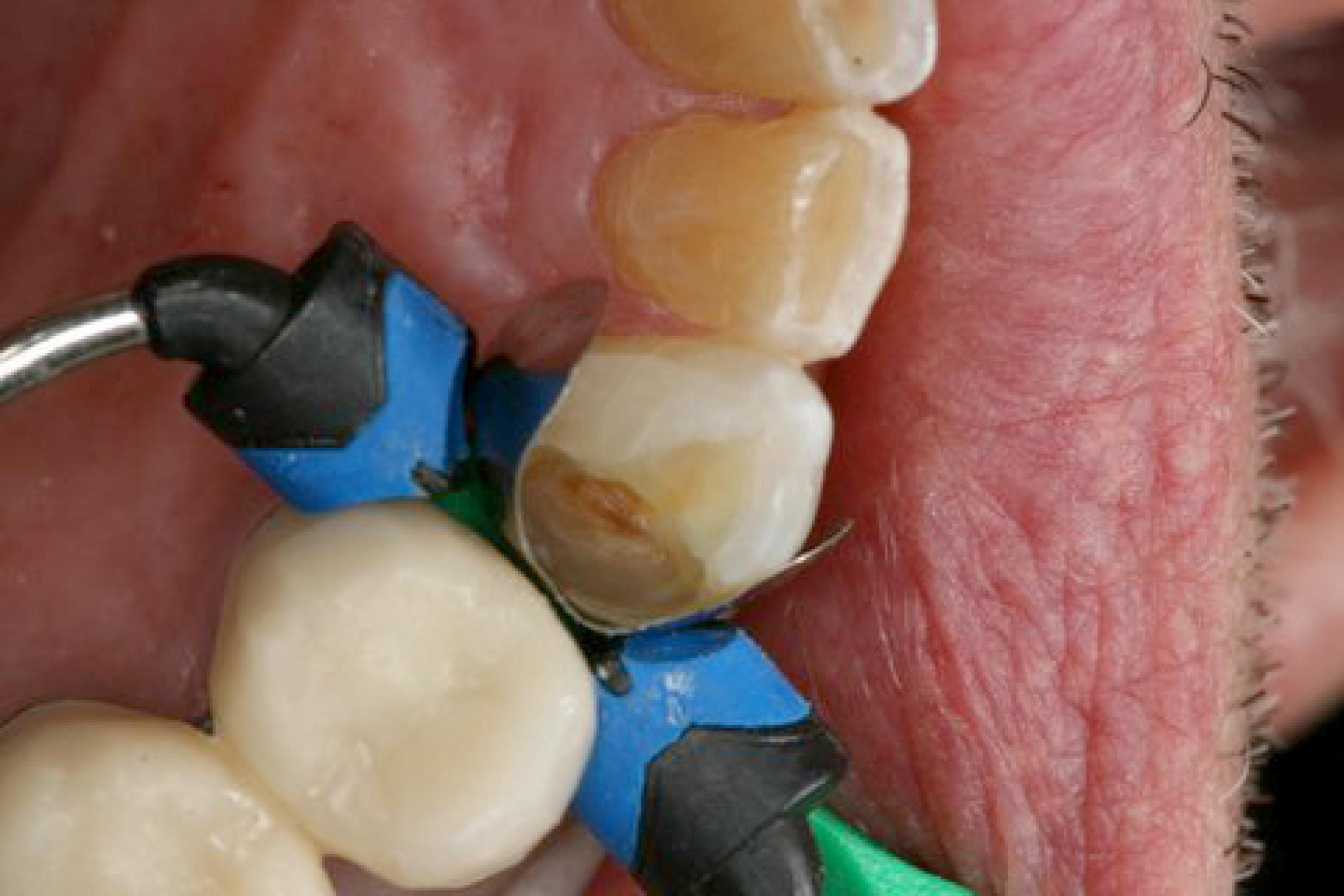 Composi-Tight® Soft Face™ 3D XR Ring