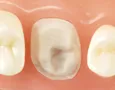 Crown Buildups